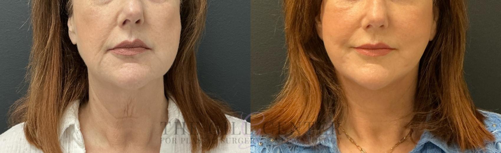 Face & Neck Lift Case 817 Before & After Front | The Woodlands, TX | The Gill Center for Plastic Surgery and Dermatology