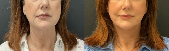Face & Neck Lift Case 817 Before & After Front | The Woodlands, TX | The Gill Center for Plastic Surgery and Dermatology