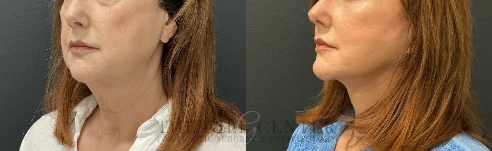 Face & Neck Lift Case 817 Before & After Left Oblique | The Woodlands, TX | The Gill Center for Plastic Surgery and Dermatology