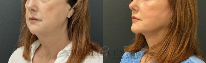 Face & Neck Lift Case 817 Before & After Left Oblique | The Woodlands, TX | The Gill Center for Plastic Surgery and Dermatology