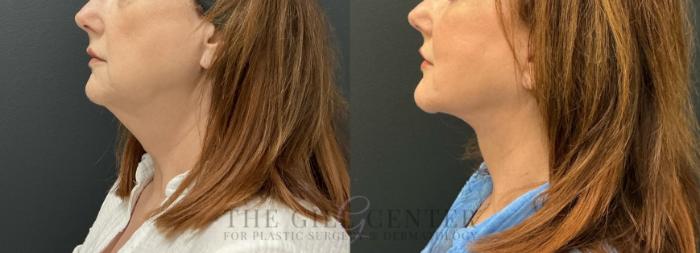 Face & Neck Lift Case 817 Before & After Left Side | The Woodlands, TX | The Gill Center for Plastic Surgery and Dermatology