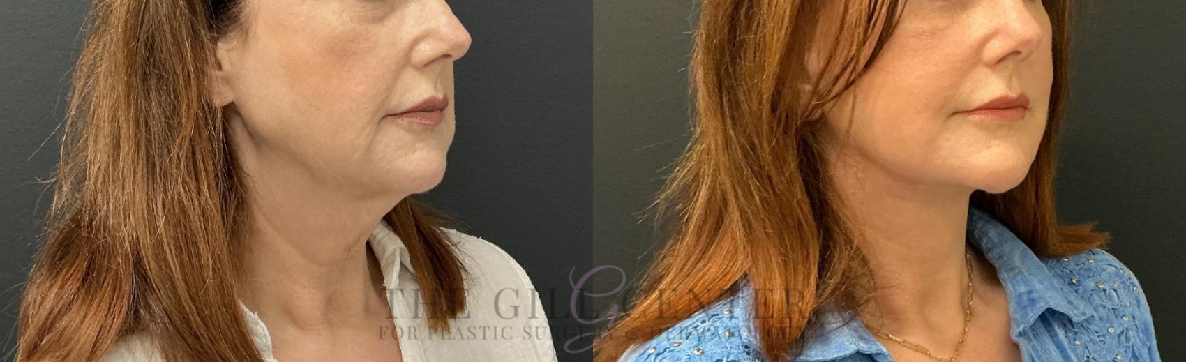Face & Neck Lift Case 817 Before & After Right Oblique | The Woodlands, TX | The Gill Center for Plastic Surgery and Dermatology