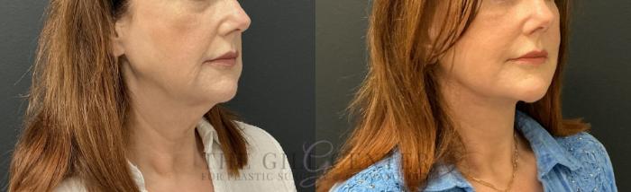 Face & Neck Lift Case 817 Before & After Right Oblique | The Woodlands, TX | The Gill Center for Plastic Surgery and Dermatology