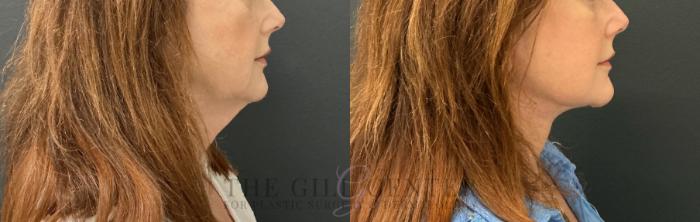 Face & Neck Lift Case 817 Before & After Right Side | The Woodlands, TX | The Gill Center for Plastic Surgery and Dermatology