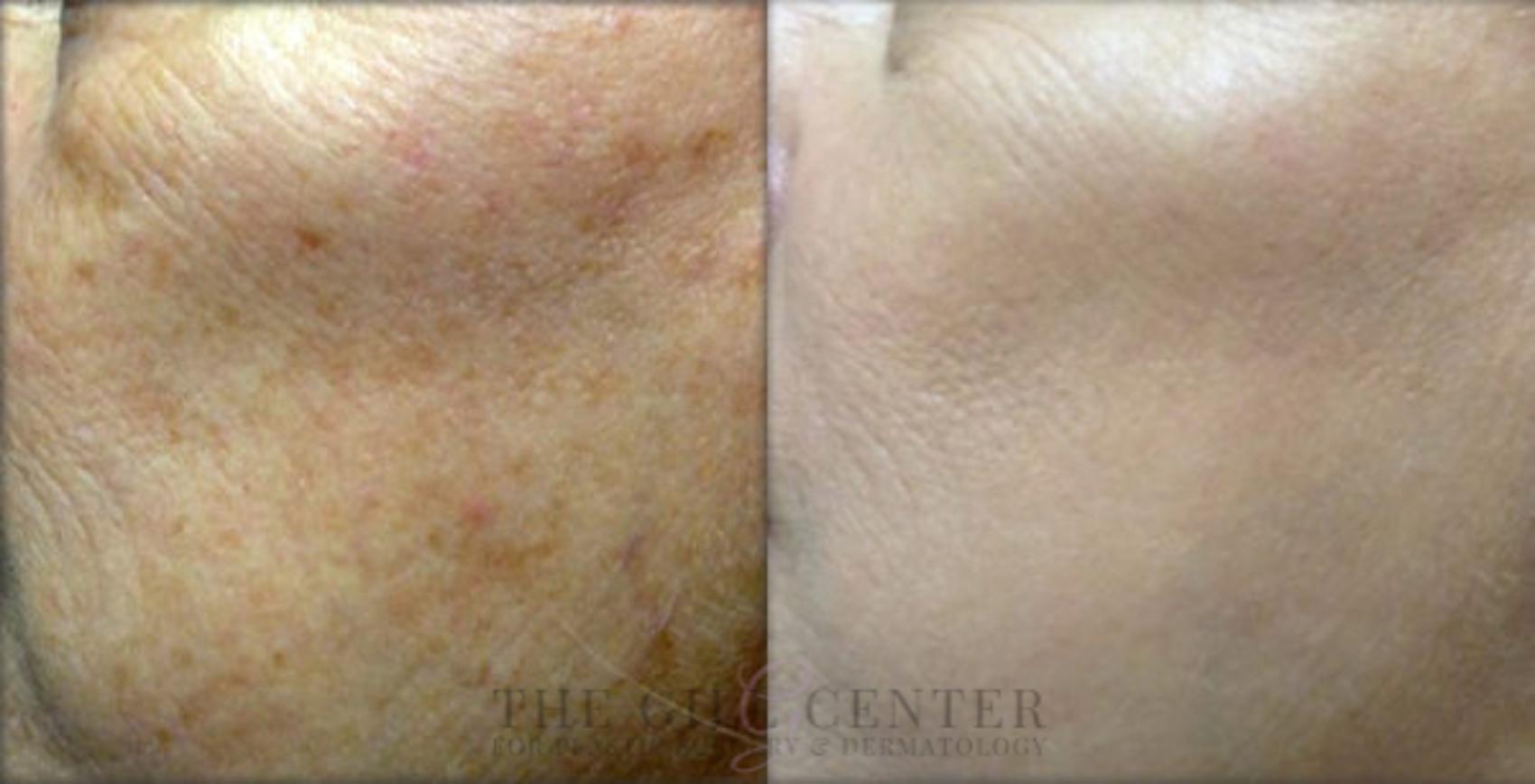 Fraxel Case 333 Before & After Left Side | The Woodlands, TX | The Gill Center for Plastic Surgery and Dermatology