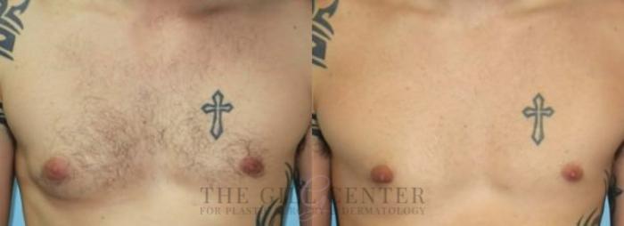 Gynecomastia Case 140 Before & After Front | The Woodlands, TX | The Gill Center for Plastic Surgery and Dermatology