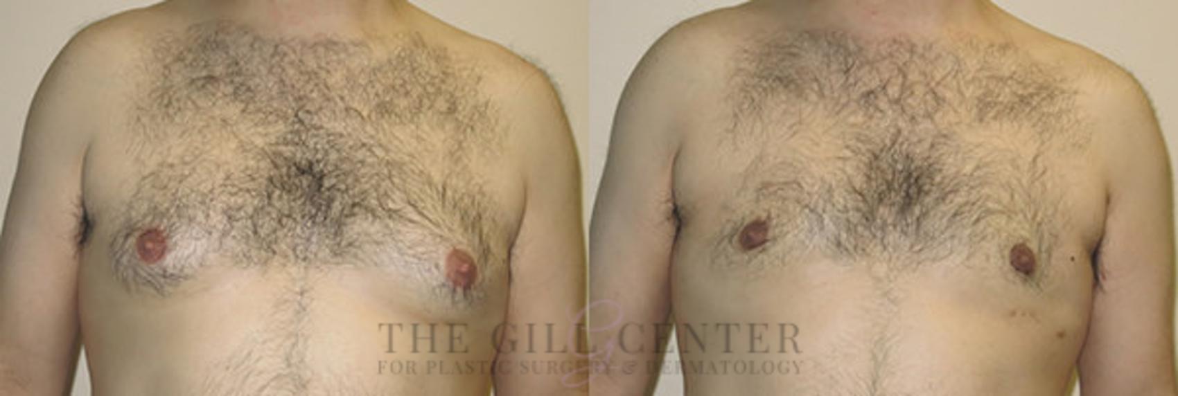 Gynecomastia Case 141 Before & After Front | The Woodlands, TX | The Gill Center for Plastic Surgery and Dermatology
