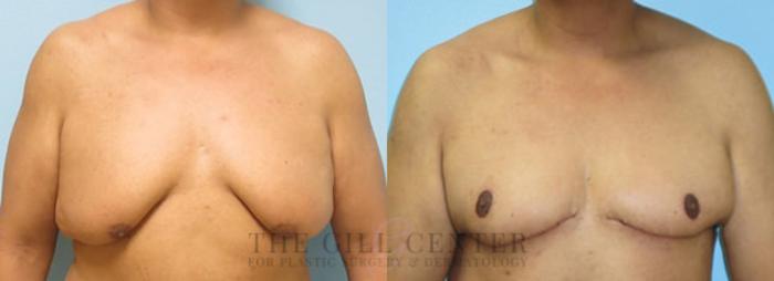 Gynecomastia Case 142 Before & After Front | The Woodlands, TX | The Gill Center for Plastic Surgery and Dermatology