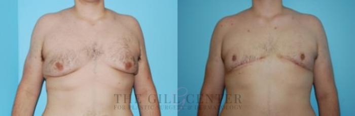 Gynecomastia Case 143 Before & After Front | The Woodlands, TX | The Gill Center for Plastic Surgery and Dermatology