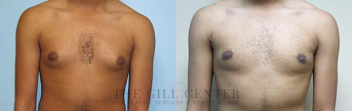 Gynecomastia Case 144 Before & After Front | The Woodlands, TX | The Gill Center for Plastic Surgery and Dermatology