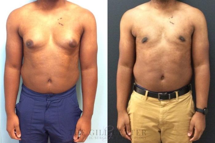 Gynecomastia Case 449 Before & After Front | The Woodlands, TX | The Gill Center for Plastic Surgery and Dermatology