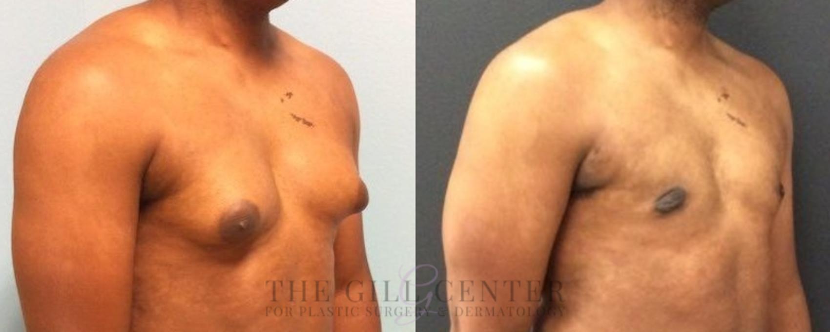 Gynecomastia Case 449 Before & After Right Oblique | The Woodlands, TX | The Gill Center for Plastic Surgery and Dermatology