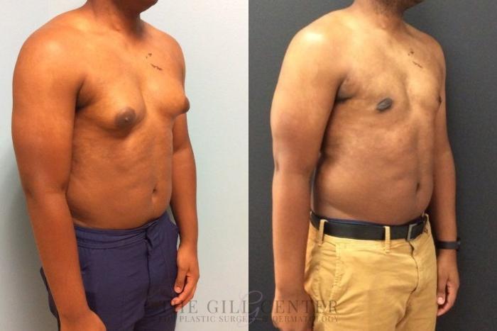Gynecomastia Case 449 Before & After Right Oblique | The Woodlands, TX | The Gill Center for Plastic Surgery and Dermatology