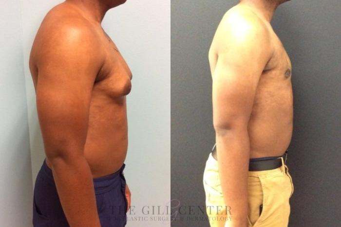 Gynecomastia Case 449 Before & After Right Side | The Woodlands, TX | The Gill Center for Plastic Surgery and Dermatology