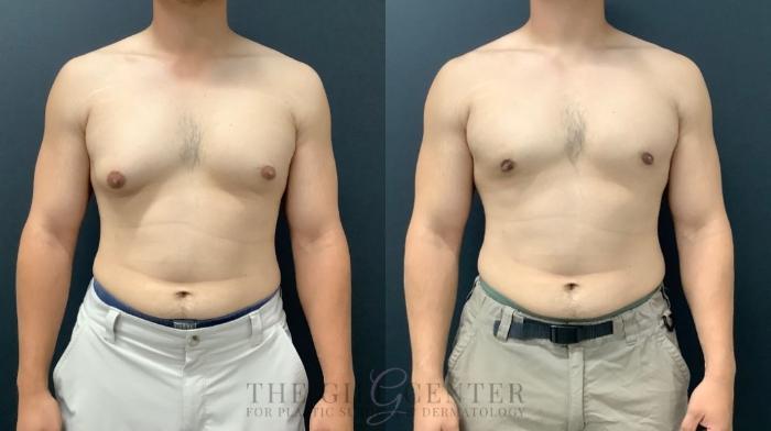 Male Body Contouring Case 573 Before & After Front | The Woodlands, TX | The Gill Center for Plastic Surgery and Dermatology