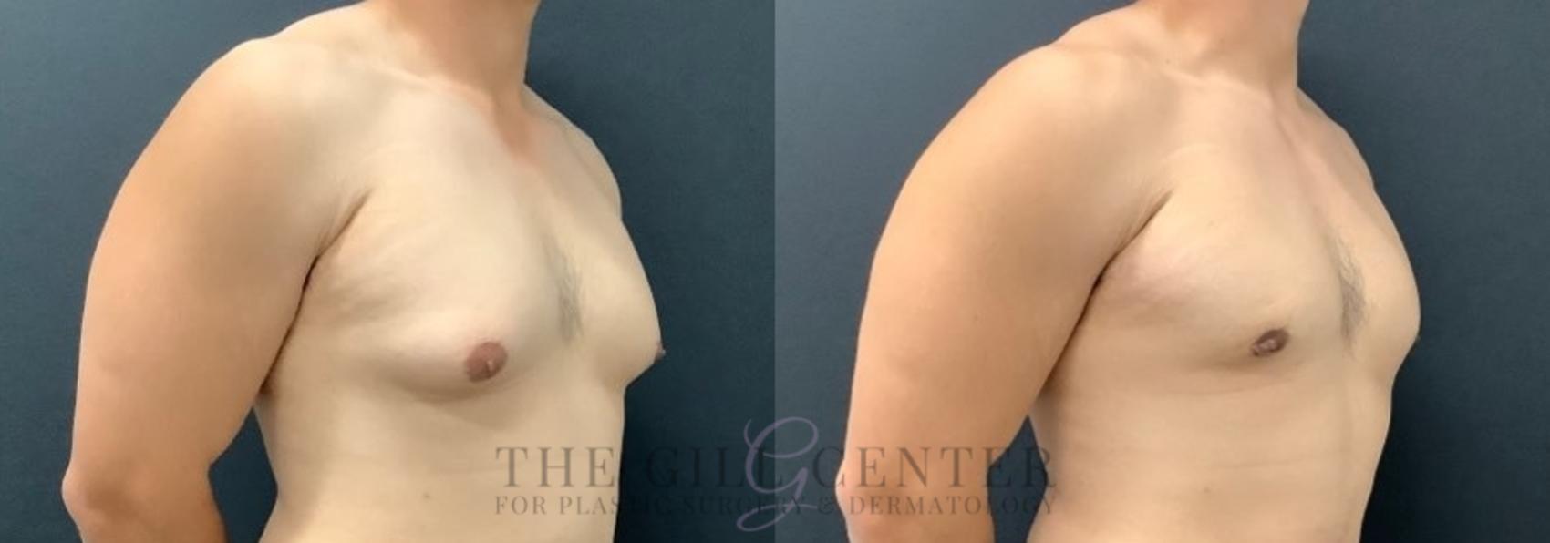 Gynecomastia Case 573 Before & After Left Oblique | The Woodlands, TX | The Gill Center for Plastic Surgery and Dermatology