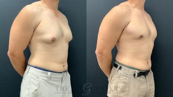 Gynecomastia Case 573 Before & After Left Oblique | The Woodlands, TX | The Gill Center for Plastic Surgery and Dermatology