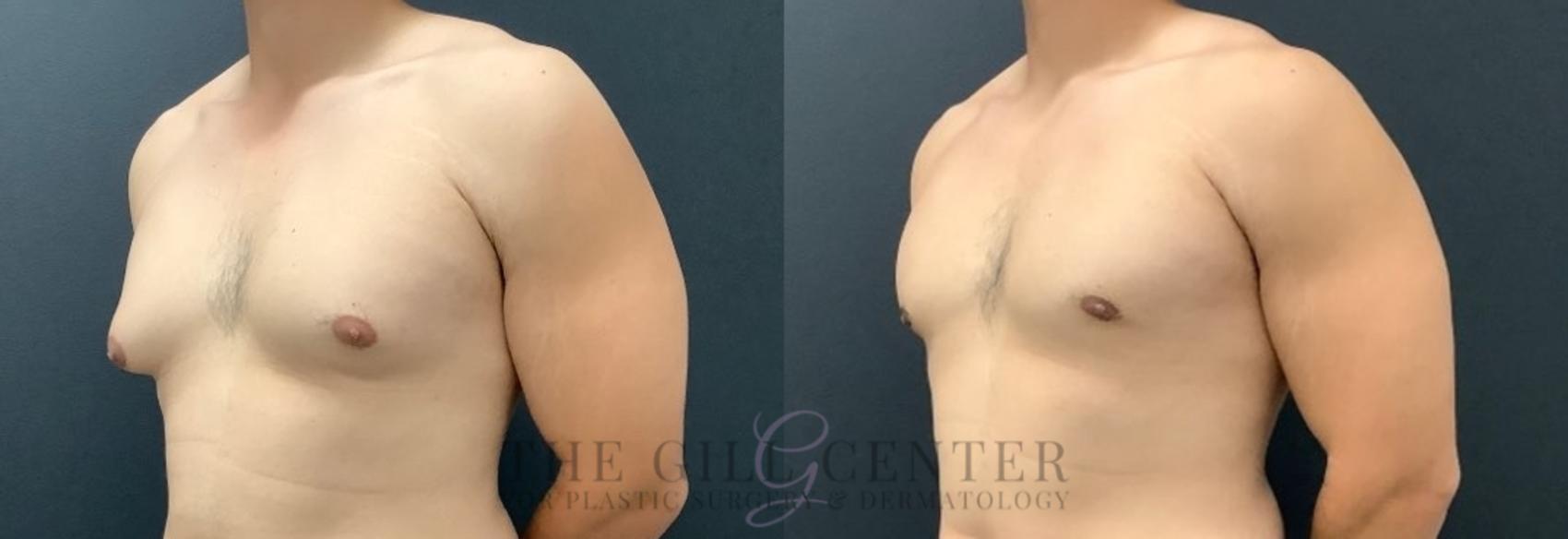 Gynecomastia Case 573 Before & After Right Oblique | The Woodlands, TX | The Gill Center for Plastic Surgery and Dermatology