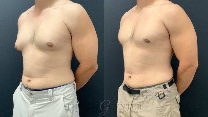Gynecomastia Case 573 Before & After Right Oblique | The Woodlands, TX | The Gill Center for Plastic Surgery and Dermatology