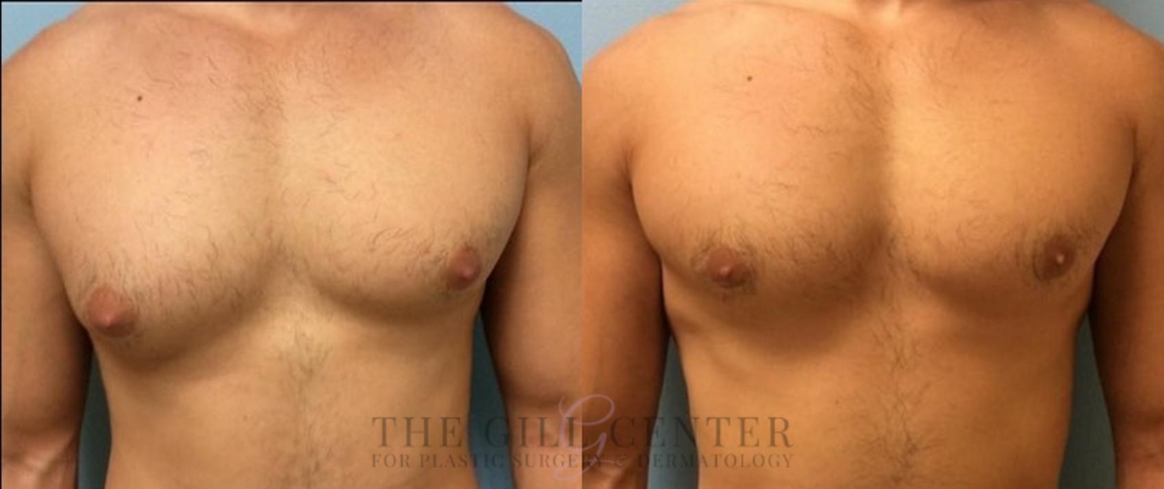 Gynecomastia Case 581 Before & After Front | The Woodlands, TX | The Gill Center for Plastic Surgery and Dermatology
