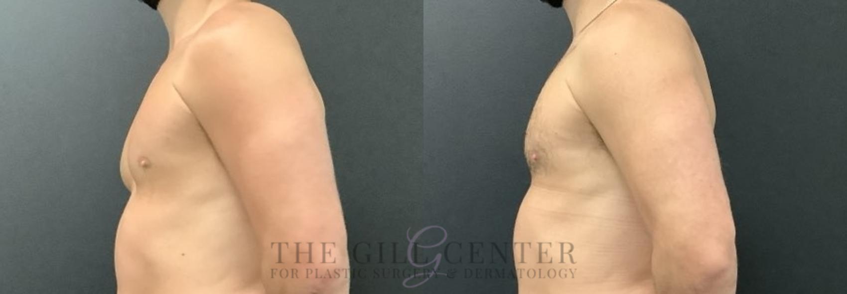 Gynecomastia Case 699 Before & After Left Oblique | The Woodlands, TX | The Gill Center for Plastic Surgery and Dermatology