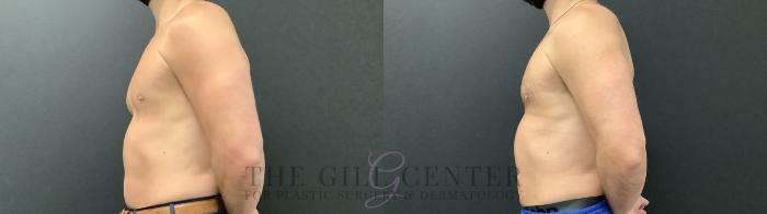 Gynecomastia Case 699 Before & After Left Oblique | The Woodlands, TX | The Gill Center for Plastic Surgery and Dermatology