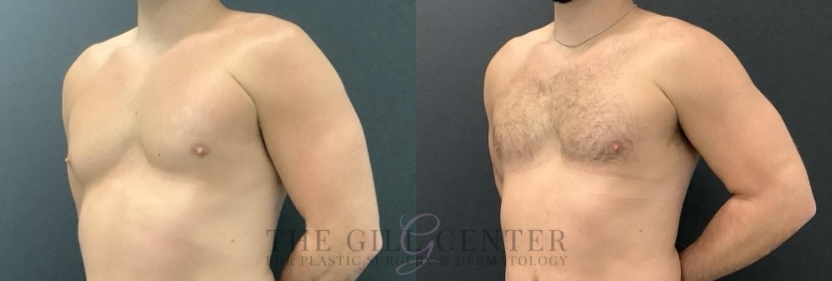 Gynecomastia Case 699 Before & After Left Side | The Woodlands, TX | The Gill Center for Plastic Surgery and Dermatology