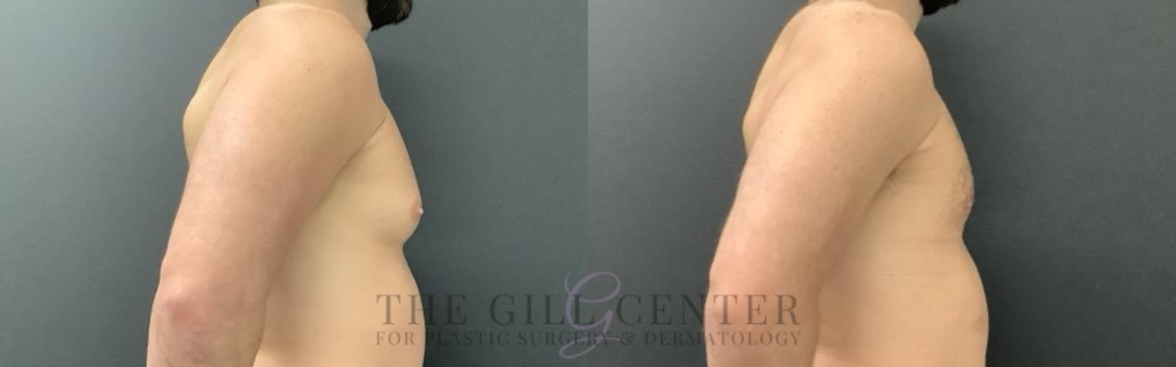 Gynecomastia Case 699 Before & After Right Oblique | The Woodlands, TX | The Gill Center for Plastic Surgery and Dermatology