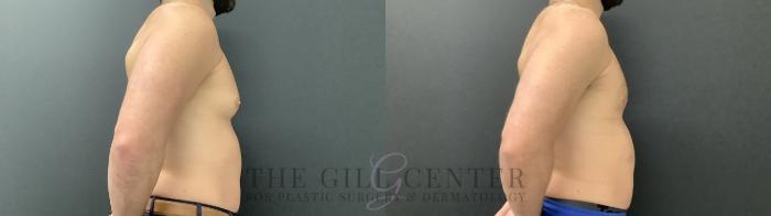 Gynecomastia Case 699 Before & After Right Oblique | The Woodlands, TX | The Gill Center for Plastic Surgery and Dermatology