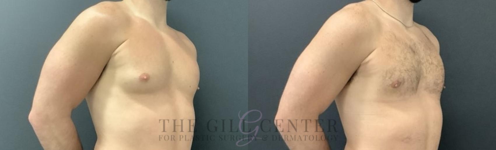 Gynecomastia Case 699 Before & After Right Side | The Woodlands, TX | The Gill Center for Plastic Surgery and Dermatology