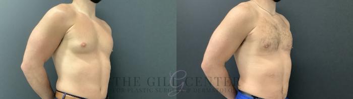 Gynecomastia Case 699 Before & After Right Side | The Woodlands, TX | The Gill Center for Plastic Surgery and Dermatology