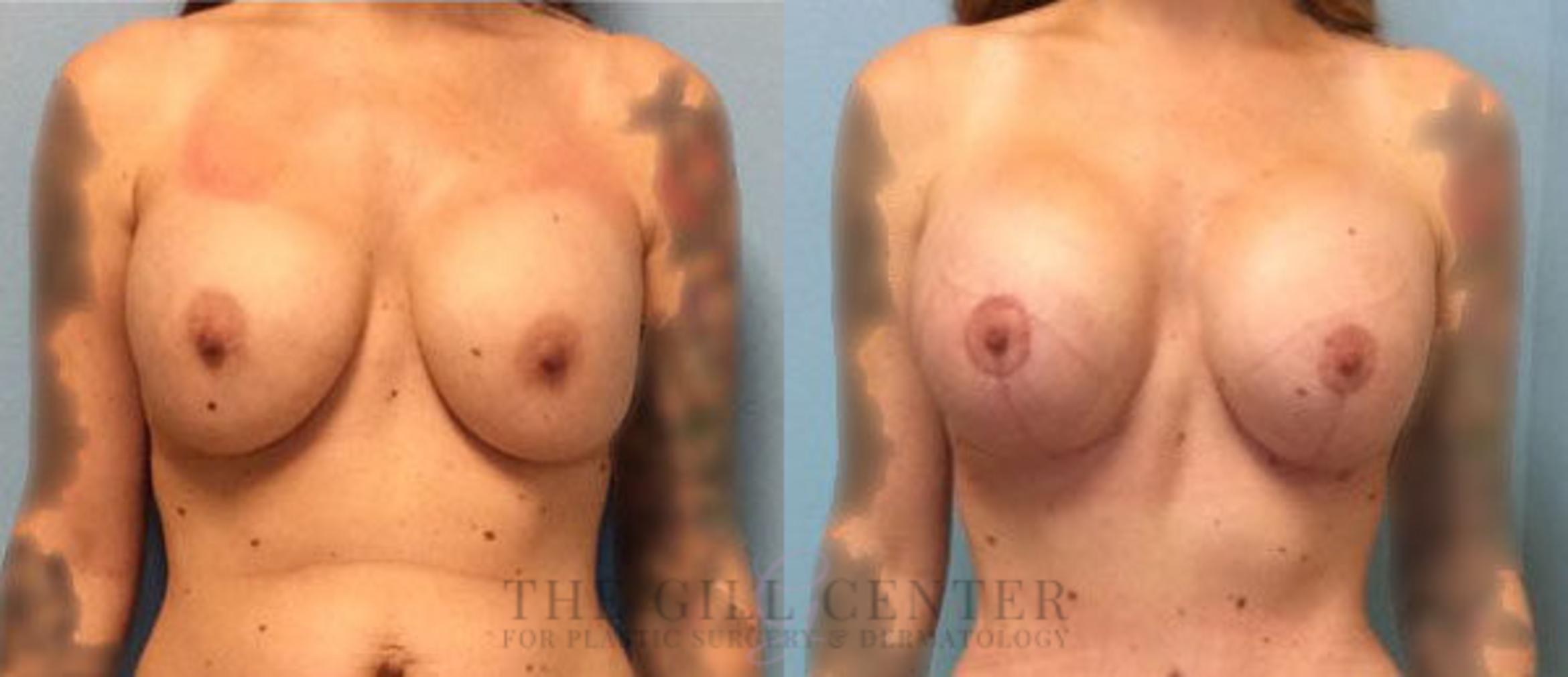 Implant Exchange Case 349 Before & After Front | The Woodlands, TX | The Gill Center for Plastic Surgery and Dermatology