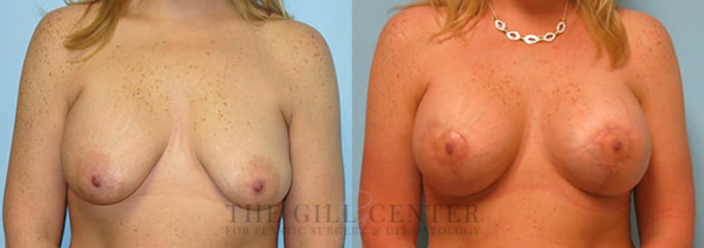 Implant Exchange Case 350 Before & After Front | The Woodlands, TX | The Gill Center for Plastic Surgery and Dermatology