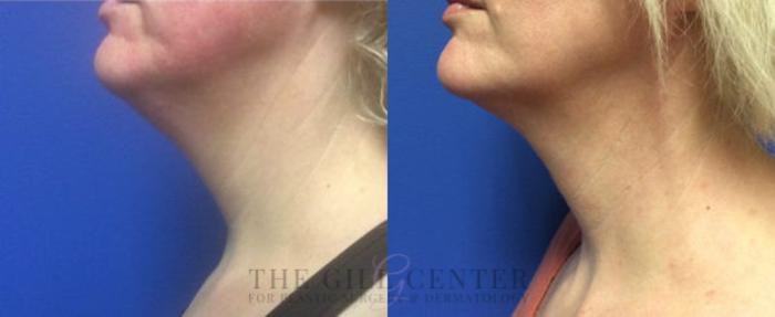 KYBELLA® Case 6 Before & After Left Side | The Woodlands, TX | The Gill Center for Plastic Surgery and Dermatology
