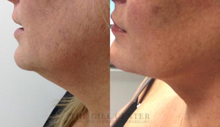 KYBELLA® Case 7 Before & After Left Side | The Woodlands, TX | The Gill Center for Plastic Surgery and Dermatology