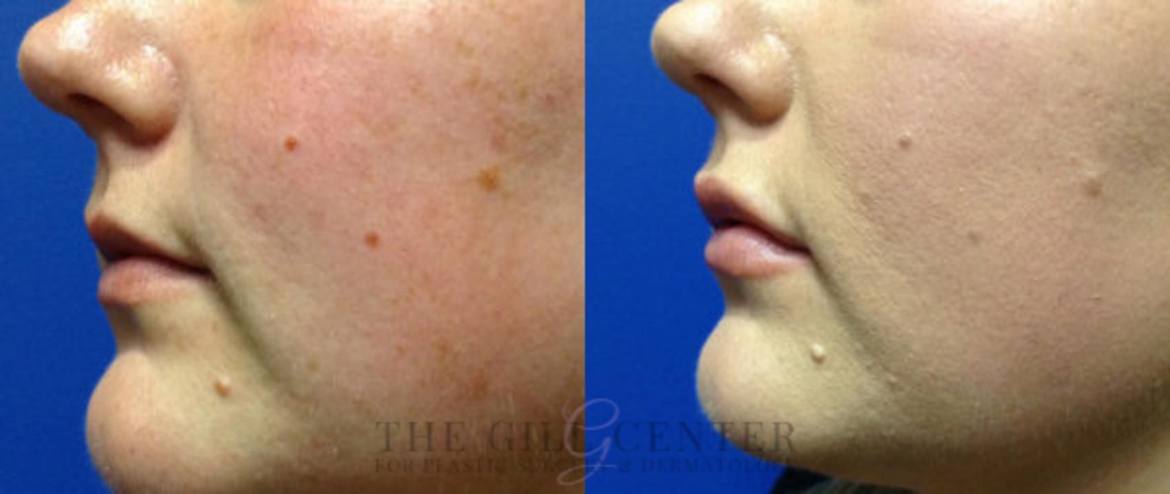 Lip Augmentation Case 362 Before & After Left Side | The Woodlands, TX | The Gill Center for Plastic Surgery and Dermatology