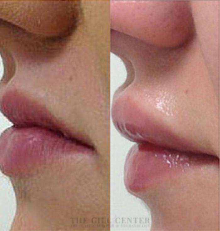 Lip Augmentation Case 363 Before & After Left Side | The Woodlands, TX | The Gill Center for Plastic Surgery and Dermatology