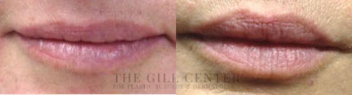 Lip Augmentation Case 364 Before & After Front | The Woodlands, TX | The Gill Center for Plastic Surgery and Dermatology