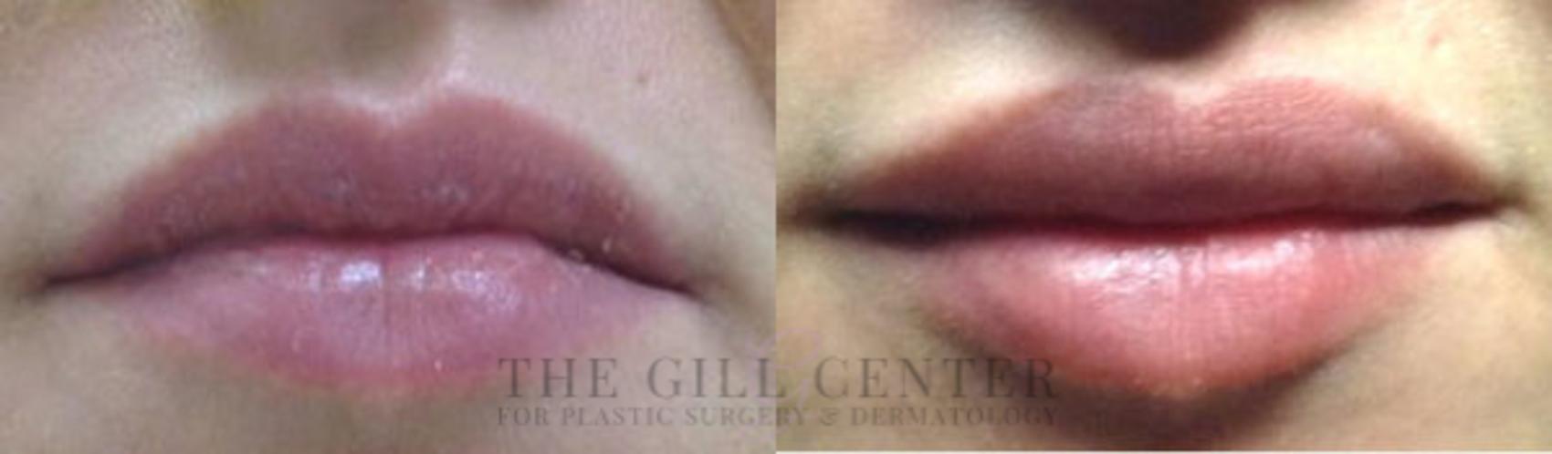 Lip Augmentation Case 365 Before & After Front | The Woodlands, TX | The Gill Center for Plastic Surgery and Dermatology