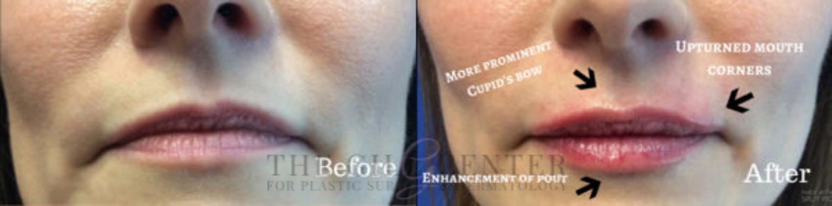 Lip Augmentation Case 366 Before & After Front | The Woodlands, TX | The Gill Center for Plastic Surgery and Dermatology