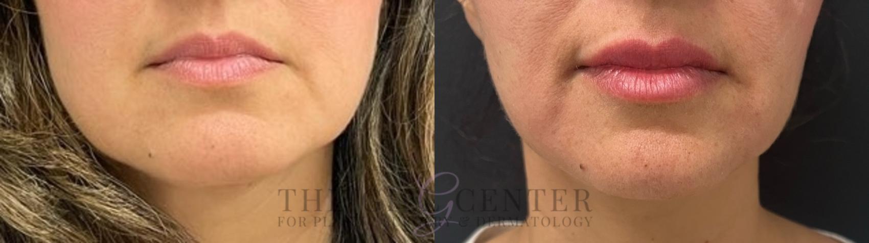 Lip Augmentation Case 538 Before & After Front | The Woodlands, TX | The Gill Center for Plastic Surgery and Dermatology