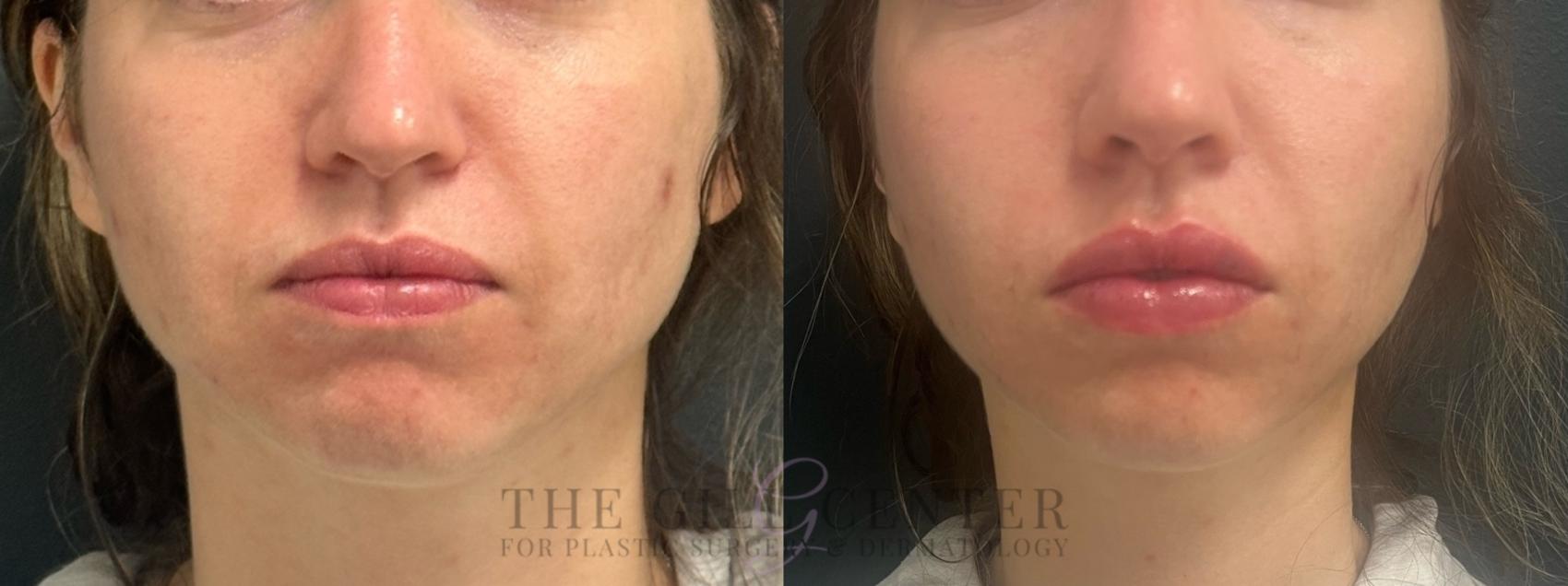 Lip Augmentation Case 661 Before & After Front | The Woodlands, TX | The Gill Center for Plastic Surgery and Dermatology