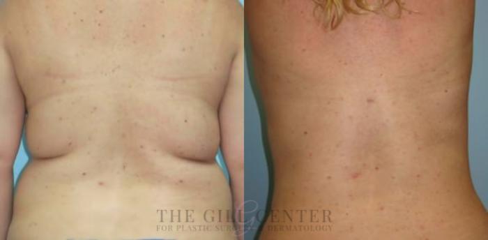Liposuction Case 155 Before & After Back | The Woodlands, TX | The Gill Center for Plastic Surgery and Dermatology