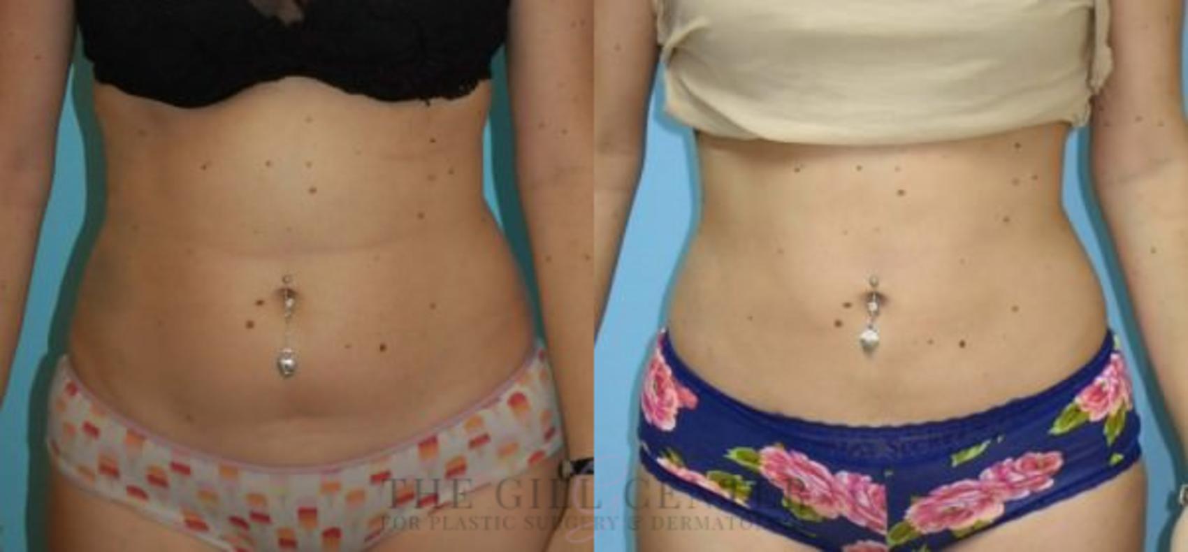 Liposuction Case 156 Before & After Front | The Woodlands, TX | The Gill Center for Plastic Surgery and Dermatology