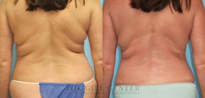 Liposuction Case 157 Before & After Back | The Woodlands, TX | The Gill Center for Plastic Surgery and Dermatology