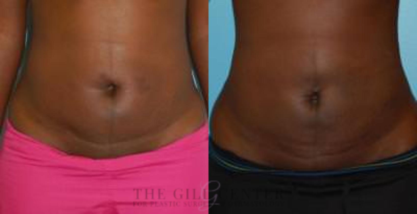 Liposuction Case 158 Before & After Front | The Woodlands, TX | The Gill Center for Plastic Surgery and Dermatology