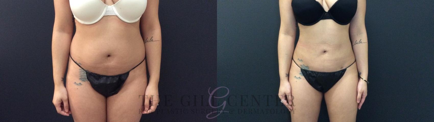 Liposuction Case 422 Before & After Front | The Woodlands, TX | The Gill Center for Plastic Surgery and Dermatology