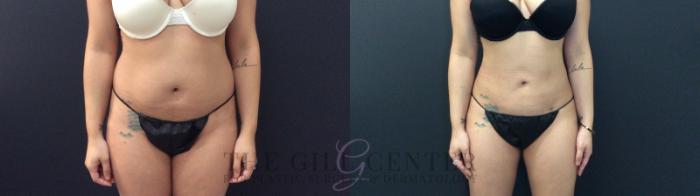 Liposuction Case 422 Before & After Front | The Woodlands, TX | The Gill Center for Plastic Surgery and Dermatology