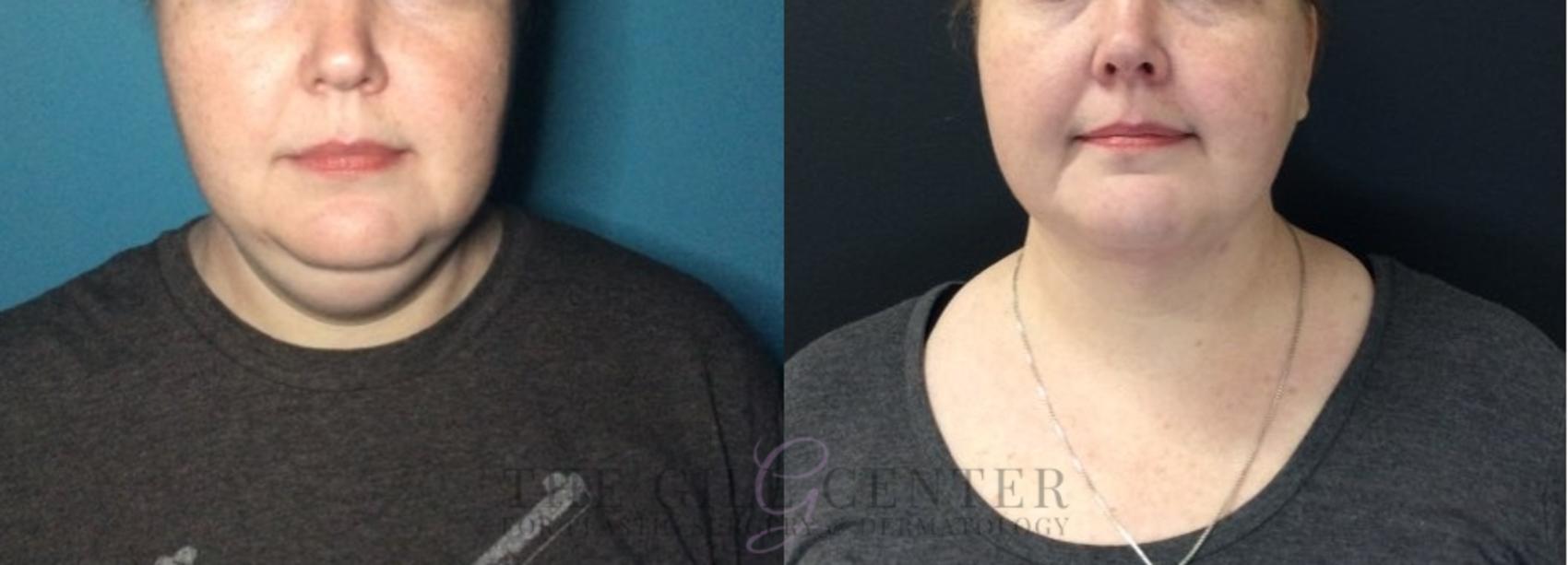 Liposuction Case 448 Before & After Front | The Woodlands, TX | The Gill Center for Plastic Surgery and Dermatology