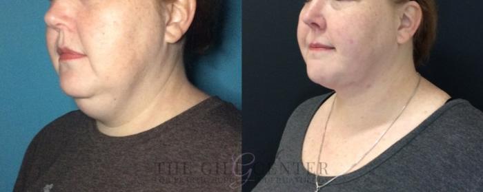 Liposuction Case 448 Before & After Left Oblique | The Woodlands, TX | The Gill Center for Plastic Surgery and Dermatology